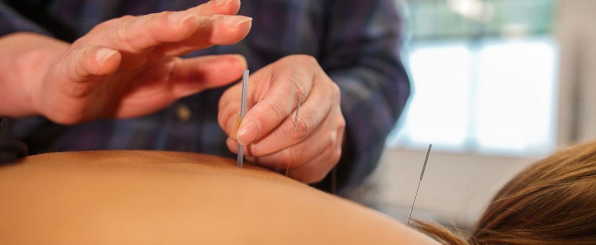Traditional Chinese Medicine Acupuncture Therapy in Richmond, BC | Richmond Blundell Physiotherapy and Sports Injury Clinic